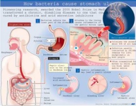 Viêm loét dạ dày: ngày càng trẻ hóa