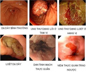 Lo sợ loét dạ dày biến chứng thành ung bướu