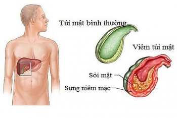 Biến chứng của sỏi mật nguy hiểm như thế nào?