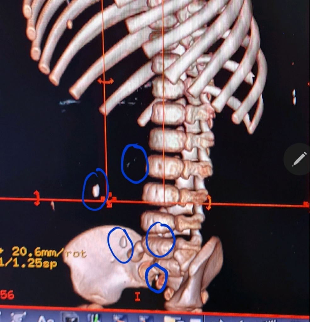 CT scan ngực bụng dựng hình cho thấy hình ảnh các mảnh kim loại rải rác