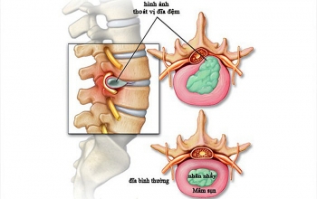 Thoát vị đĩa đệm - Đừng tự ý điều trị!