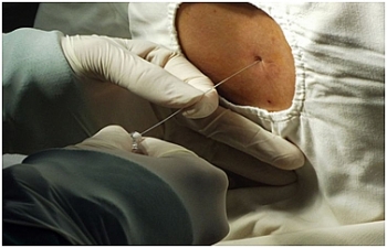 Một bệnh nhân bị viêm màng não do nhiễm liên cầu khuẩn lợn