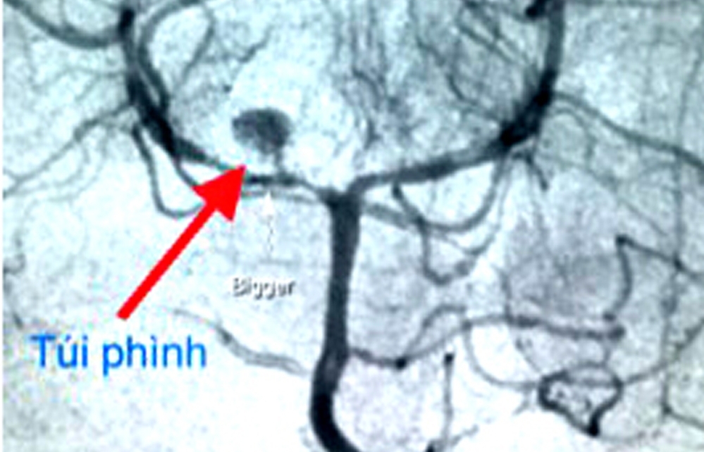 Cứu sống bệnh nhi 3 tuổi bị vỡ phình mạch máu não