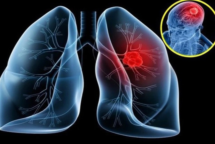 Phát hiện ung thư phổi "lẩn trốn" trong cơ thể như thế nào?