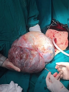 Phẫu thuật thành công khối u buồng trứng 6,2 kg