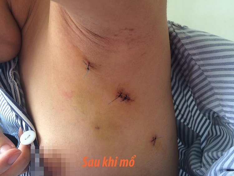 lan dau tien mo noi soi u xo tuyen vu khong de lai seo