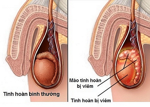 hai bo con viem tinh hoan vi bi quai bi