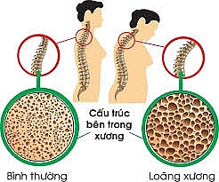 Hơn 150 nghìn người bị gãy xương do loãng xương