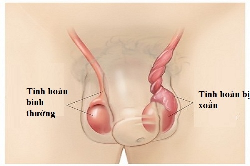 Hai thiếu niên phải cắt bỏ tinh hoàn vì hoại tử