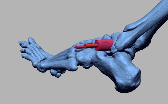 Sáng kiến khoa học 2022: Thiết bị định vị phẫu thuật nội soi xương 3D