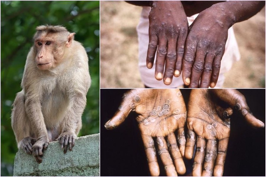 TP HCM tăng cường các biện pháp ứng phó bệnh đậu mùa khỉ