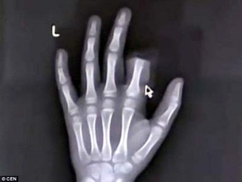Bé trai tự cắt lìa ngón tay vì bị cấm dùng smartphone
