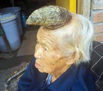 [VIDEO] Kỳ lạ cụ bà 87 tuổi mọc sừng trên đầu
