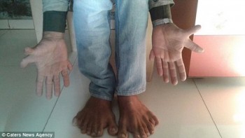 Người đàn ông sở hữu 28 ngón tay, chân