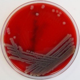 Xung quanh bệnh vi khuẩn "ăn thịt người": Mắc bệnh không dễ