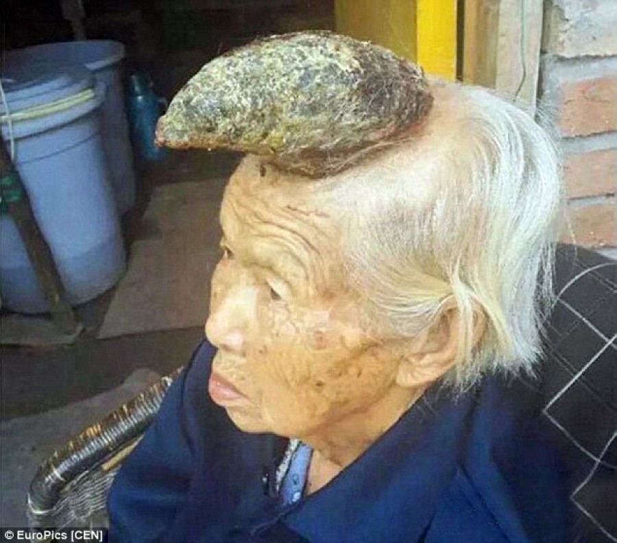 Cụ bà 87 tuổi mọc sừng dài 12cm trên đầu