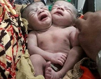 Bé gái 2 đầu chào đời ở Bangladesh