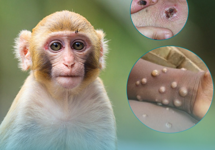 Bộ Y tế hướng dẫn chẩn đoán, điều trị và phòng bệnh đậu mùa khỉ