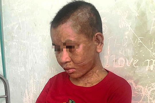 Bộ trưởng LĐTB&XH đề nghị xử nghiêm vụ cô gái ở Kon Tum bị bạo hành