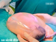 Kỳ lạ bé sơ sinh chào đời nằm nguyên trong bọc ối ở Thanh Hóa