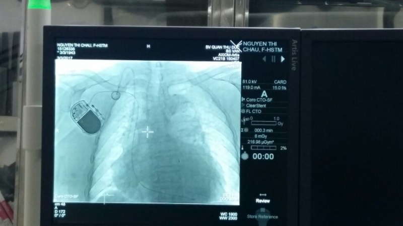 Bệnh viện quận Thủ Đức triển khai cấy máy tạo nhịp tim vĩnh viễn