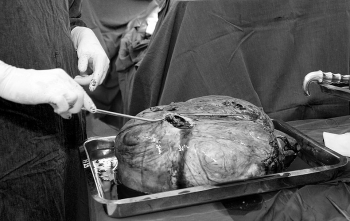 Phẫu thuật khối u buồng trứng nặng 30kg cho cụ bà 78 tuổi