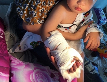 Nối bàn tay bị đứt vì thang cuốn cho bé 17 tháng