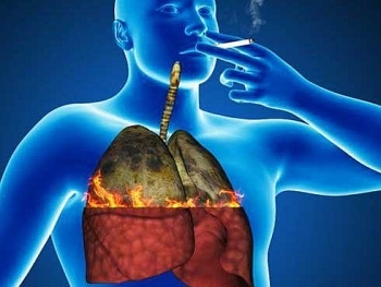 Tại sao ung thư phổi thường phát hiện ở giai đoạn muộn?