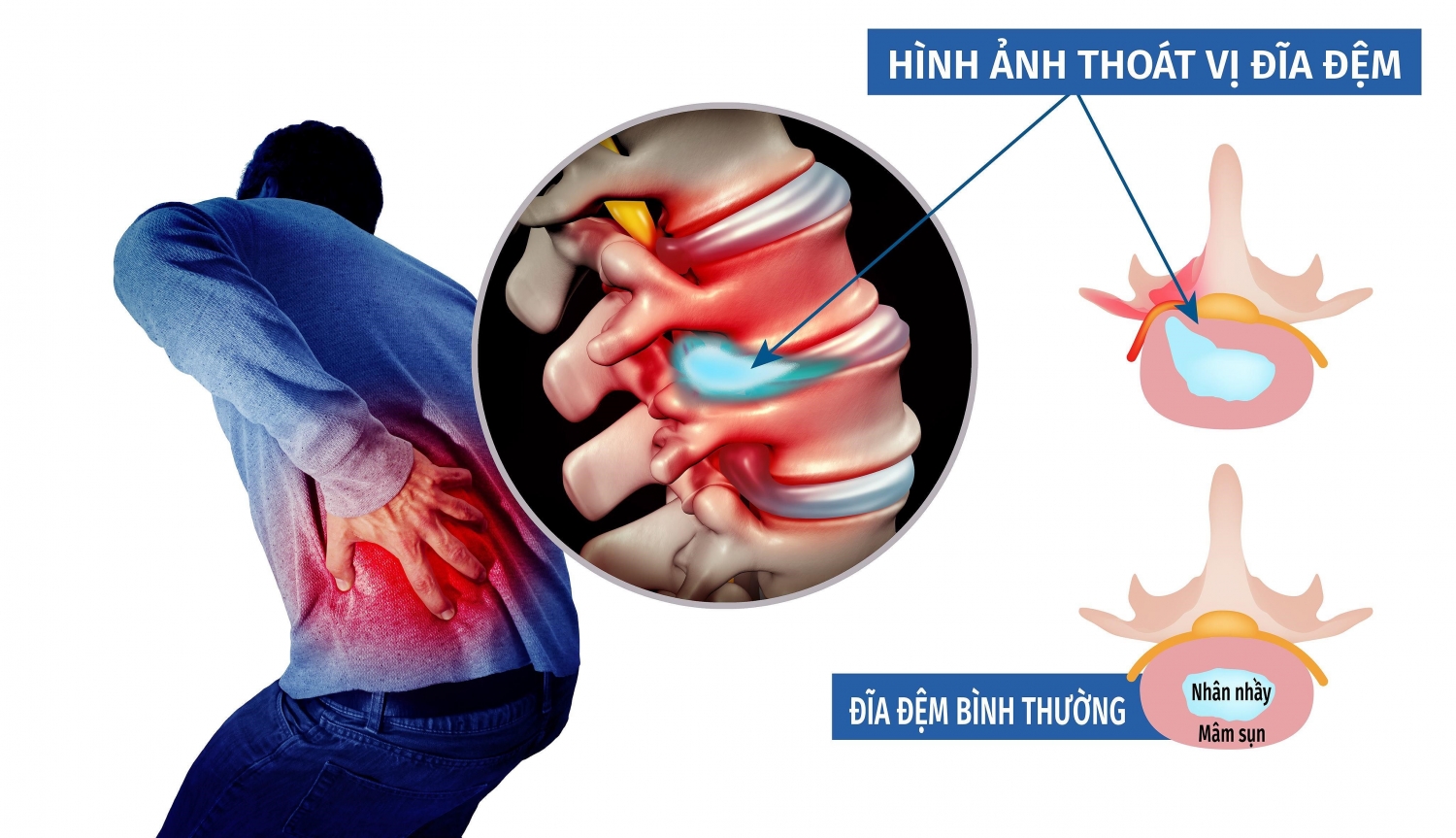 Các triệu chứng báo hiệu bệnh thoát vị đĩa đệm