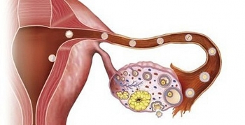 Dấu hiệu điển hình của ung thư buồng trứng