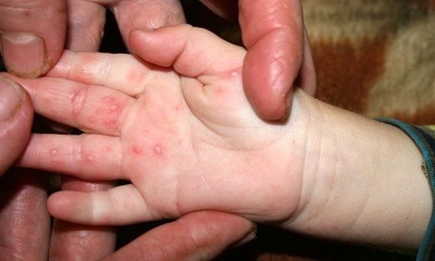 Sẽ sớm có vắc xin phòng bệnh tay chân miệng cho trẻ em?