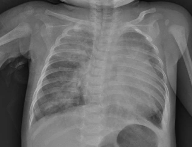 Xquang ngực cho thấy hình ảnh tổn thương thâm nhiễm phổi nặng lan tỏa 2 phế trường, bóng tim to