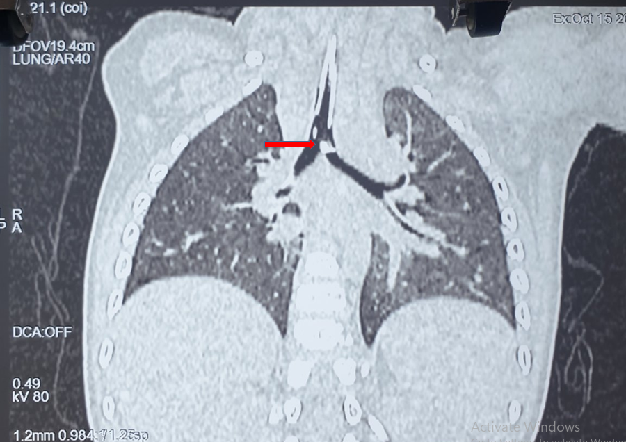 Hình ảnh CT scan ngực cho thấy mảnh dị vật 