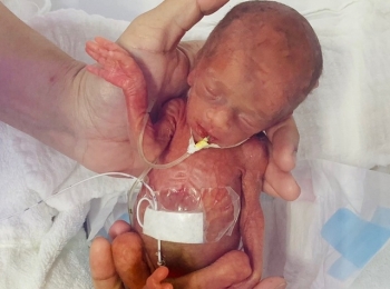 Kỳ tích cứu sống em bé nặng 400gram, nhỏ lọt thỏm trong lòng bàn tay