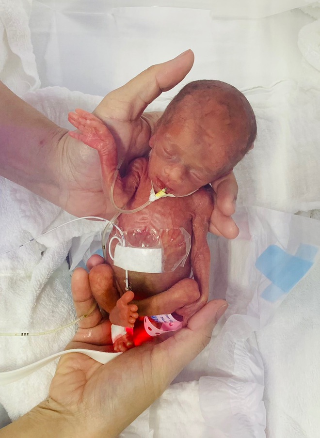 Kỳ tích cứu sống em bé nặng 400gram, nhỏ lọt thỏm trong lòng bàn tay - 1