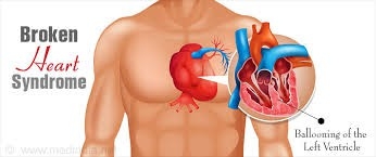 Hội chứng "trái tim vỡ": Tổn thương tim do stress