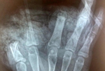 Thiếu niên 14 tuổi bị cụt 3 ngón tay vì nghịch pin quạt tích điện