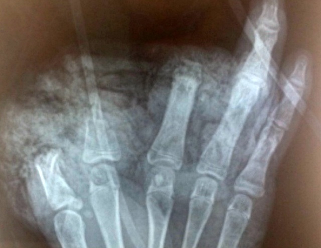 Thiếu niên 14 tuổi bị cụt 3 ngón tay vì nghịch pin quạt tích điện - 1