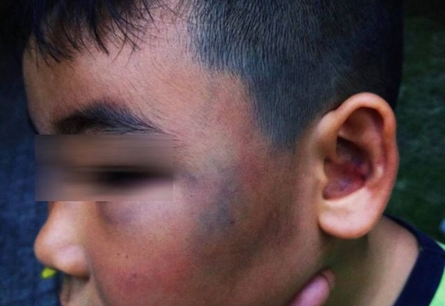 Bé 8 tuổi bị đánh bầm tím mặt vì nghịch đàn gà