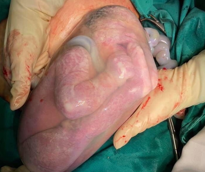Phú Thọ: Cặp song sinh chào đời, một bé vẫn còn nguyên trong bọc ối