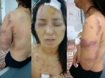 Phú Thọ: Nghi vấn cô giáo bị chồng bạo hành