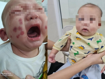 Bé trai 6 tháng tuổi mắc căn bệnh cực hiếm, chưa từng gặp ở Việt Nam