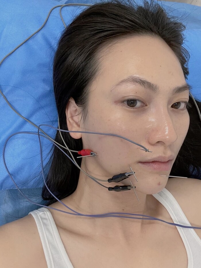 Tin hot giải trí ngày 22/6: Sau phẫu thuật tuyến giáp, diễn viên Phương Anh Đào bị lệch méo khung môi
