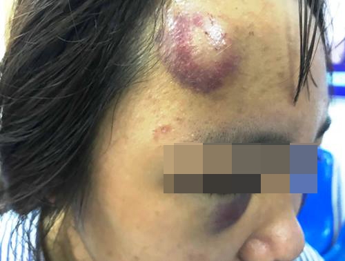 Nữ sinh bị đánh hội đồng: ‘Một số bạn nữ cầm mũ bảo hiểm đập vào đầu em’
