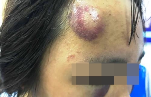 Nữ sinh bị đánh hội đồng: ‘Một số bạn nữ cầm mũ bảo hiểm đập vào đầu em’