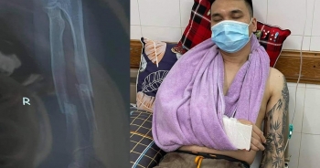 Ca sĩ Khắc Việt bị gãy xương cổ tay, hủy toàn bộ lịch diễn