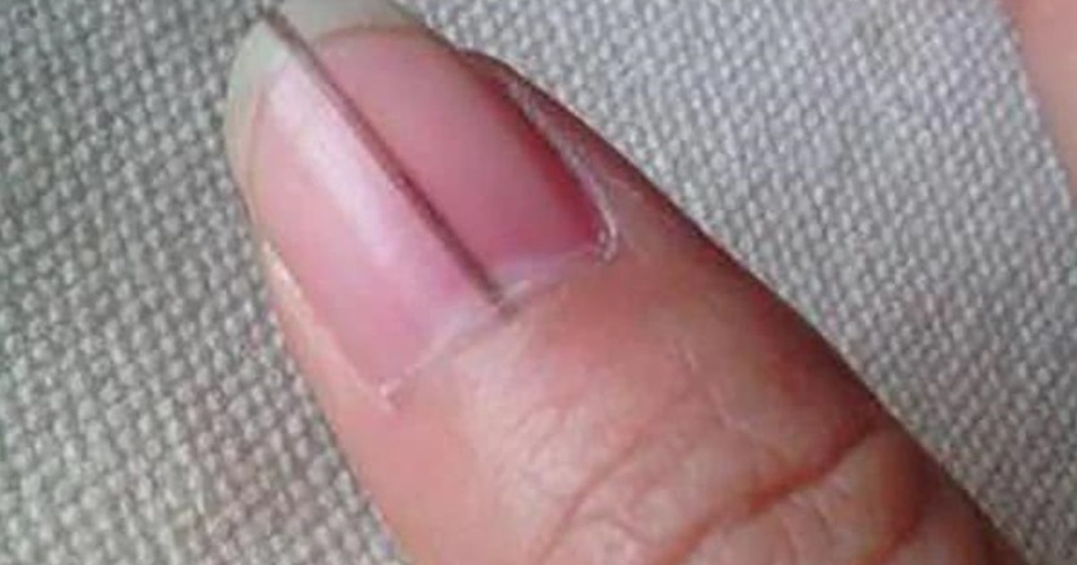 Những dấu hiệu bất thường trên bàn tay "chỉ điểm" ung thư giai đoạn đầu