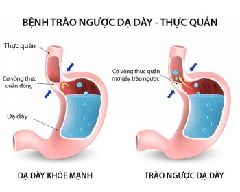 3 dấu hiệu trào ngược dạ dày