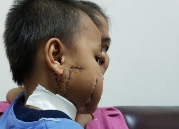 Bé trai 6 tuổi bị cánh quạt công nghiệp "chém" rách mặt và cổ