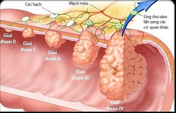 Việt Nam đứng thứ 18 trên thế giới về ung thư dạ dày